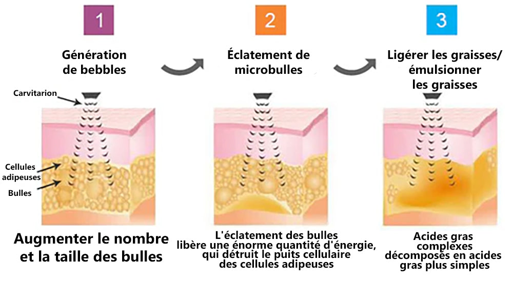 2024 Dernière version 🔥CZTICLE™ Ultrasons Liposuccion Désintoxication bracelet - Équilibrer l'énergie du corps  🎁(Offre à durée limitée + Recommandation du médecin)